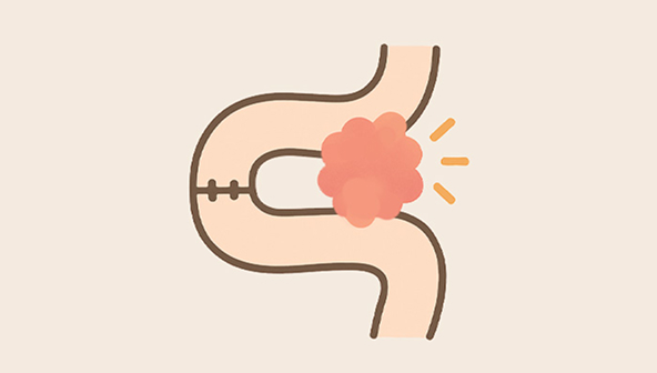 Surgical site complications