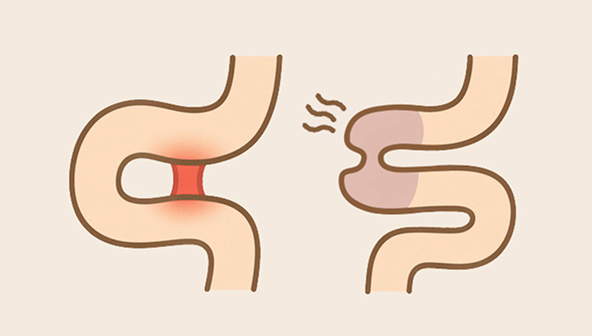Bowel adhesion / obstruction