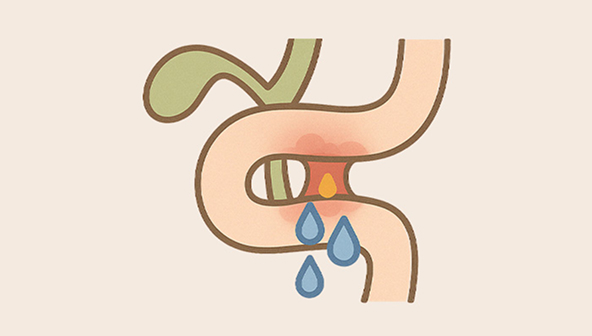 Bile leakage