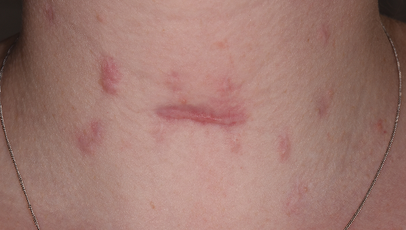Neck scar