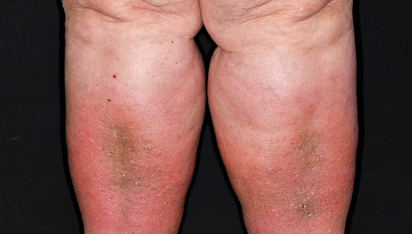 Lymphedema