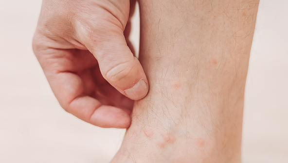 Surgical site complications