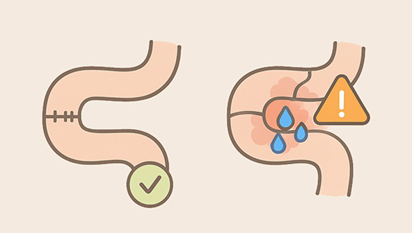 Anastomotic leakage